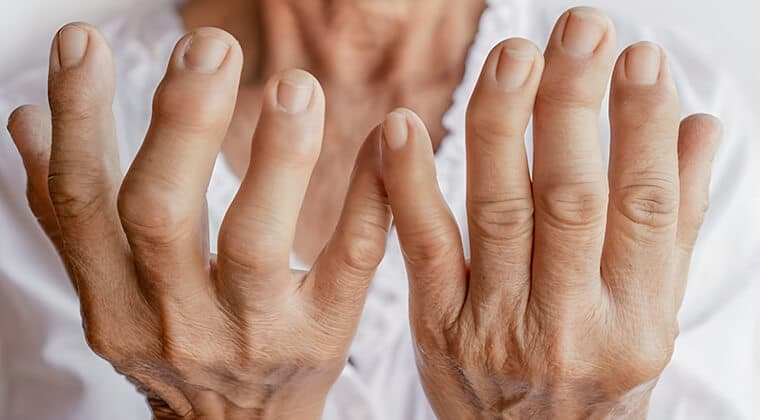 Artrosis (Osteoartritis)