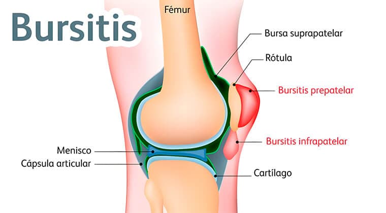 Bursitis