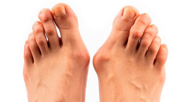 Hallux valgus