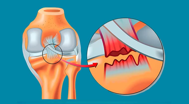 Lesiones de ligamentos