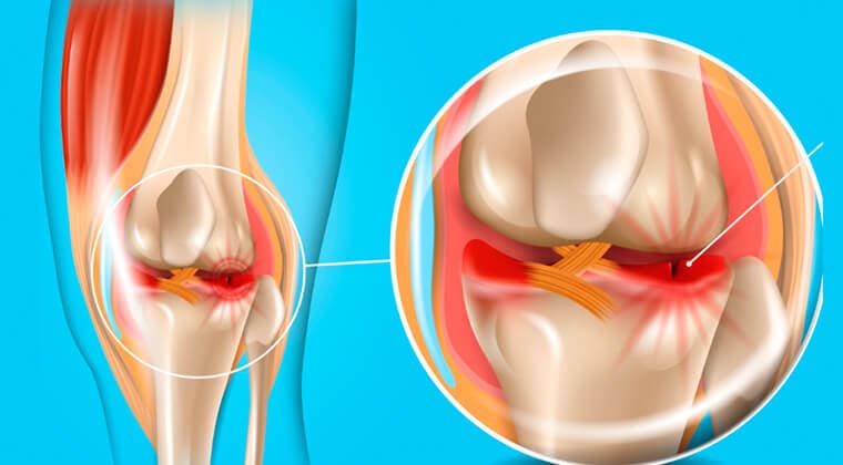 Lesiones meniscales