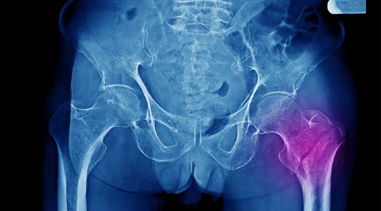 Osteoporosis con fracturas por fragilidad