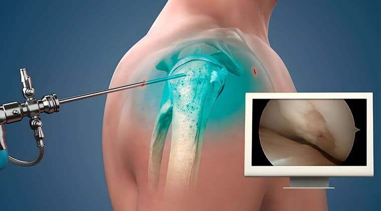 Consulta médica - artroscopia-de-hombro