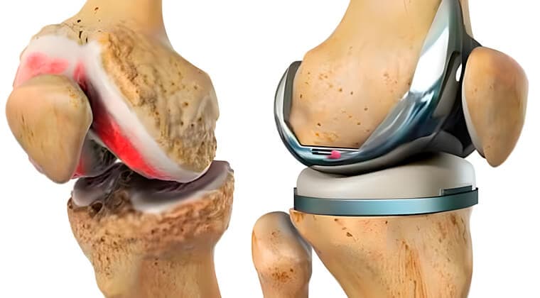 Prótesis de rodilla